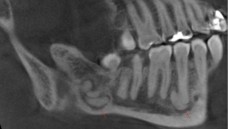 Ein aktueller Fall von Odontom(e) im Unterkiefer bei einer Mittvierzigerin: Dichte, amorphe Formation in der Nähe der  Zahnwurzeln. (Quelle: Wikipedia CC 3.0)