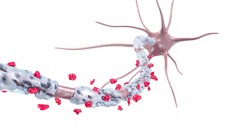 Bei MS kommt es zur irreversiblen Schädigung der Myelinscheide von Nervenzellen im ZNS. (Foto:  AG Visuell / Fotolia)